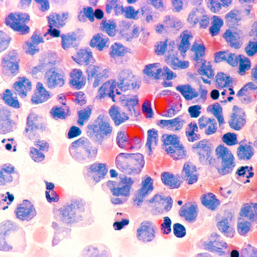 https://commons.wikimedia.org/wiki/File:Leukemia_(aml).jpg
